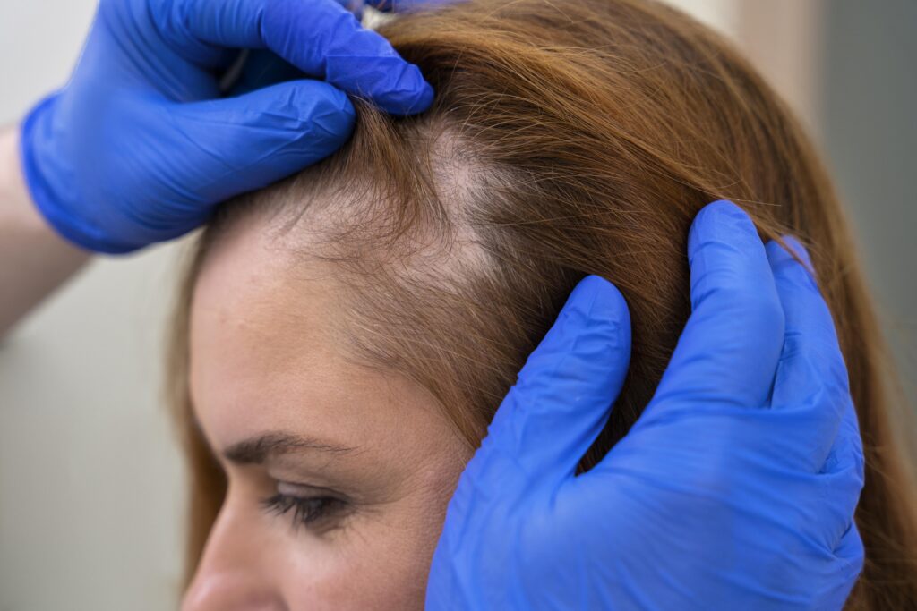 Alopecia 05 tipos e tratamentos para queda de cabelo